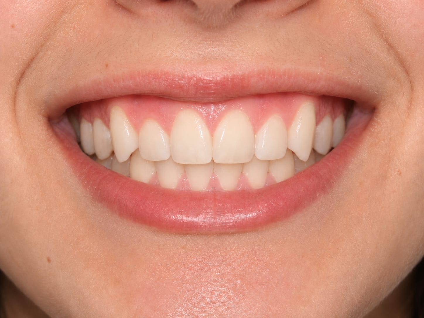 Smile after treatment with straightened, aligned teeth