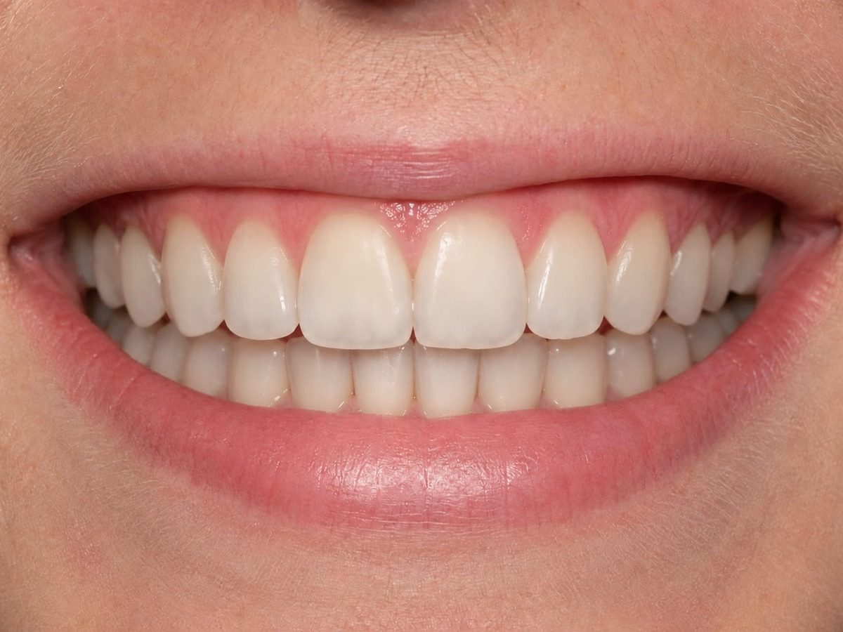 Smile after treatment with the chipped front tooth restored and the edges made even