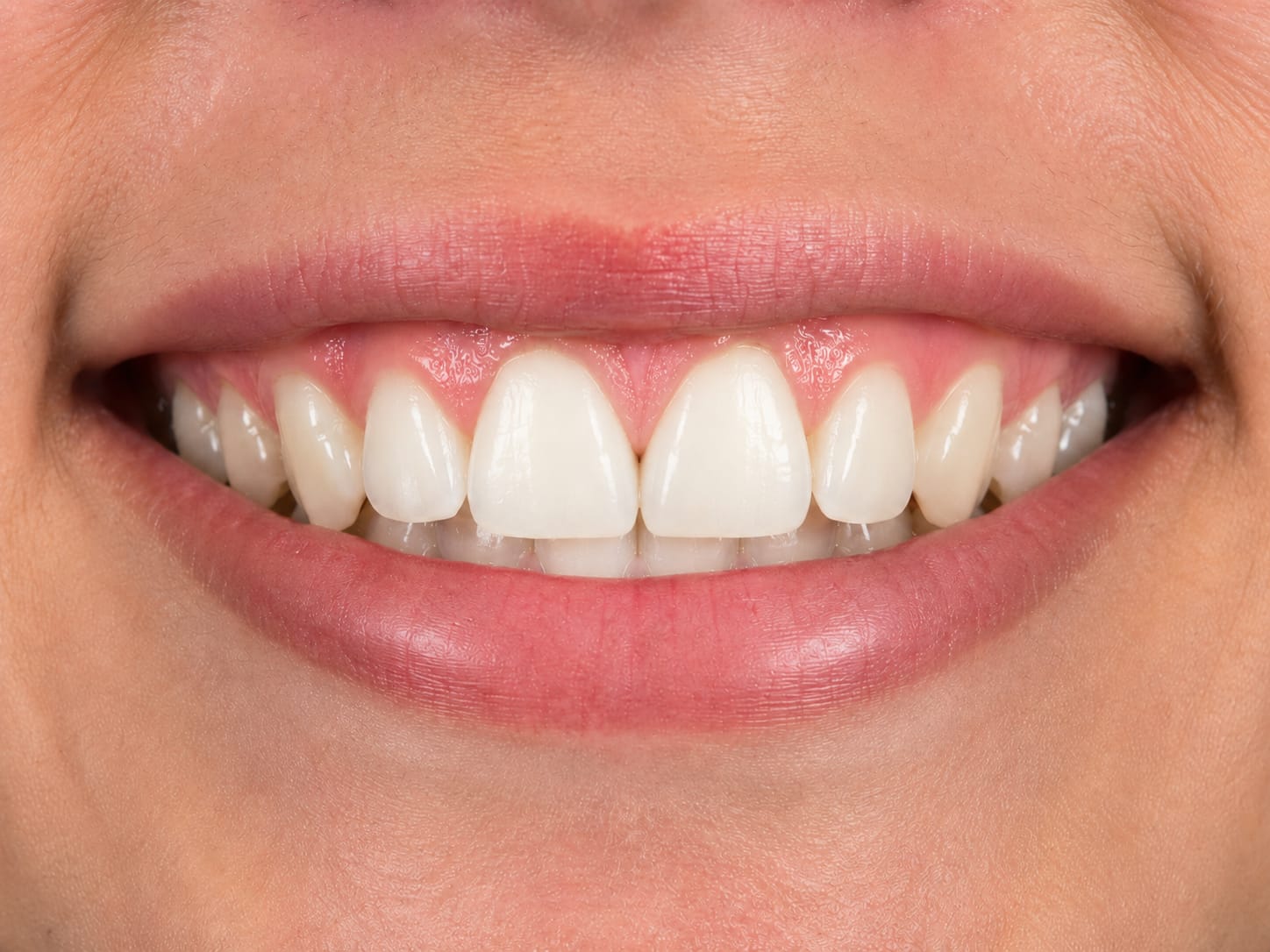 Smile after treatment with the gap between the front teeth closed