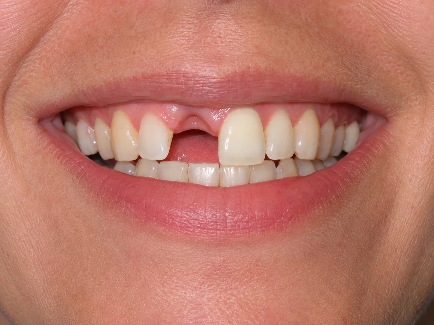 A smile with a missing tooth — the kind of gap a dental bridge can restore