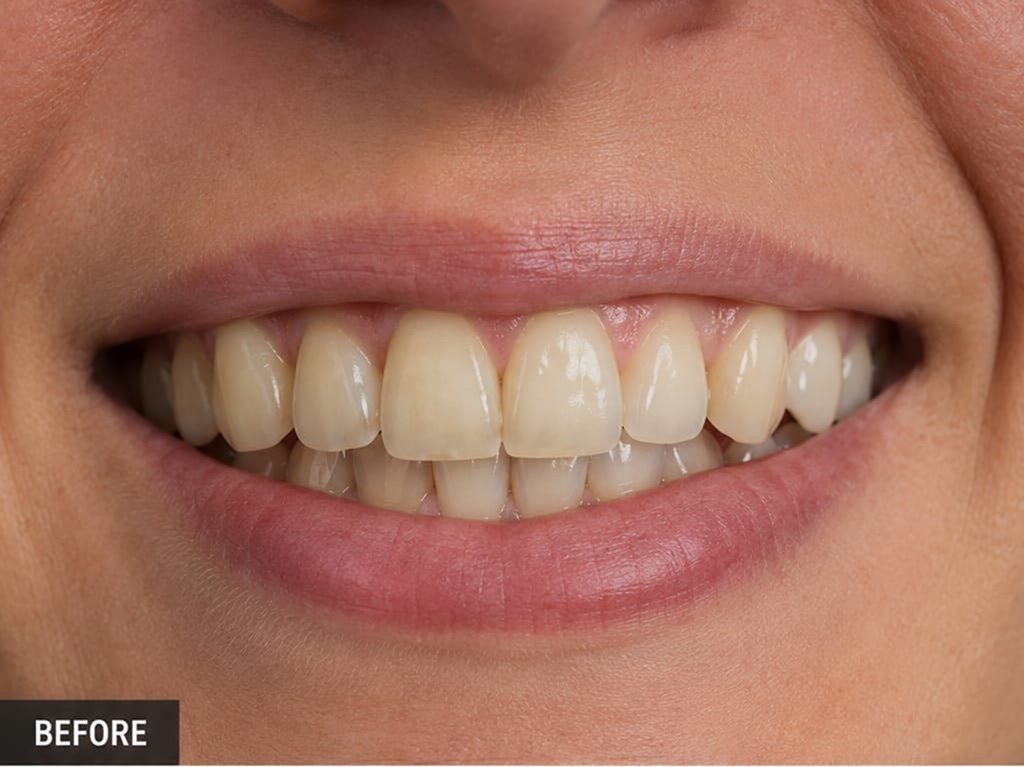 Before professional whitening: teeth with yellow discolouration